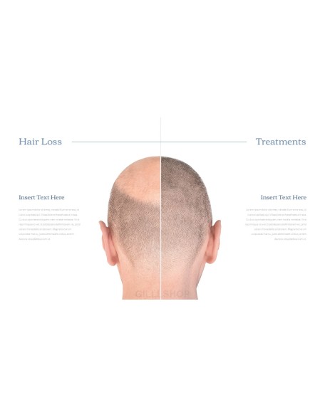 Hair Loss Treatments Business plan PPT Templates