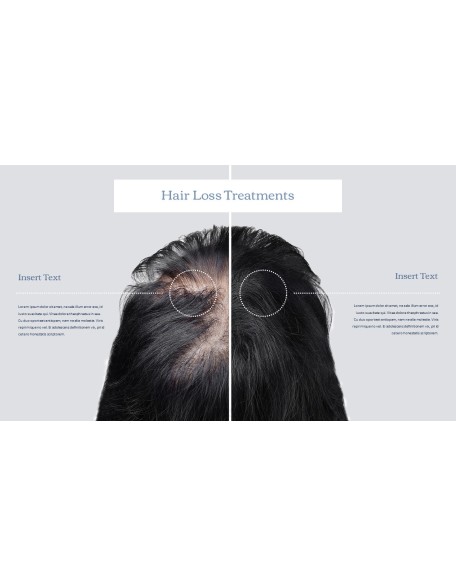 Hair Loss Treatments Business plan PPT Templates